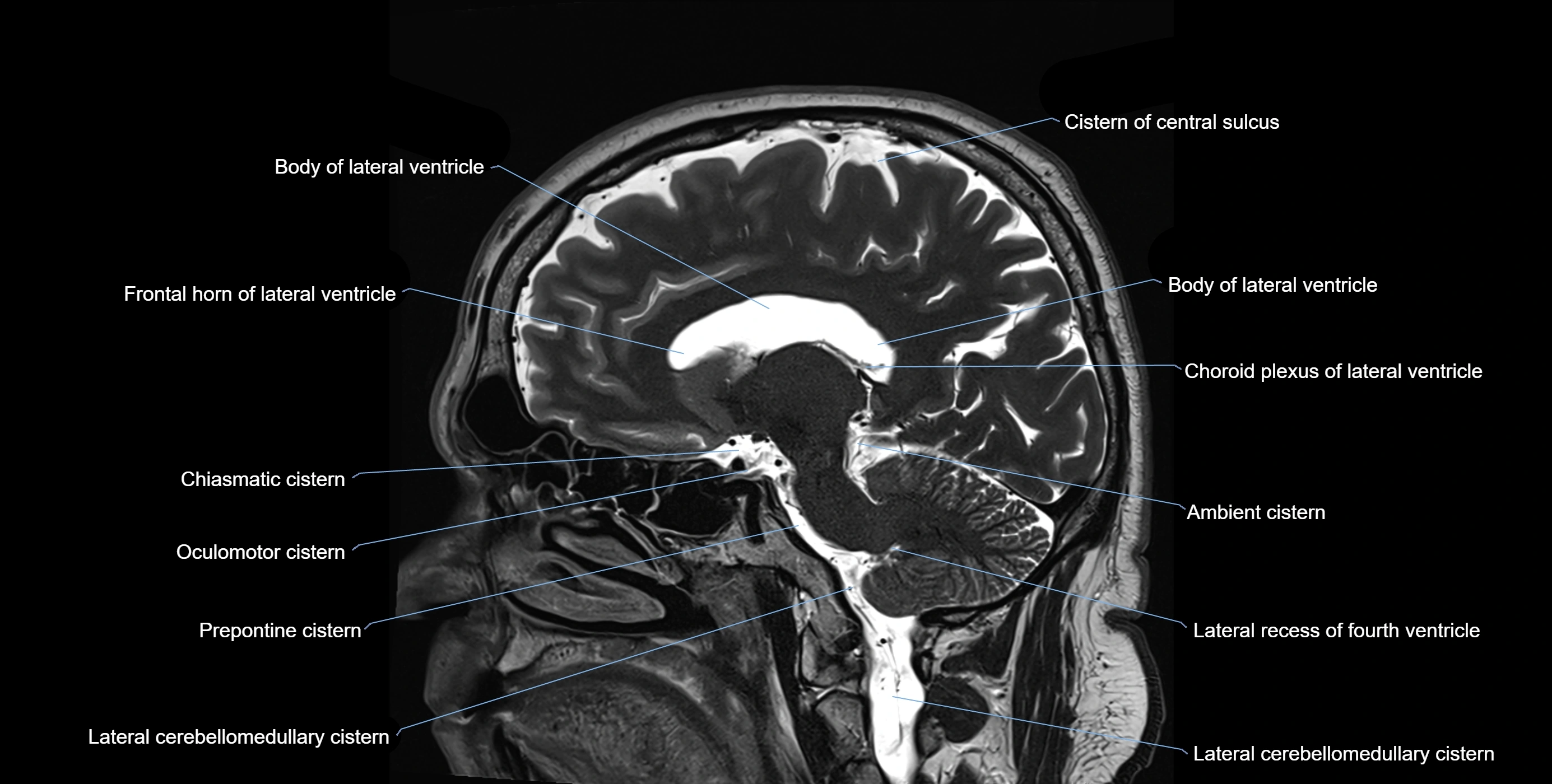 Brain cisterns  and ventricles sagittal anatomy 3T MRI image-img-00001-00024.webp
